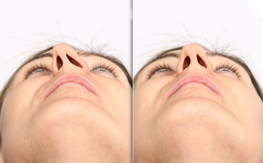 Deviated Septum